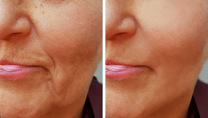 filler-acido-ialuronico-prima-dopo